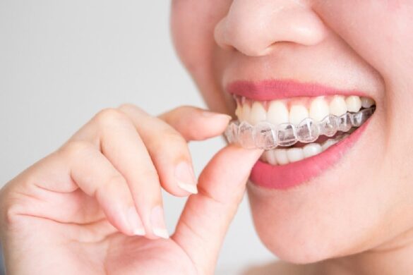 21 Best Braces Tips for Adults Over 50