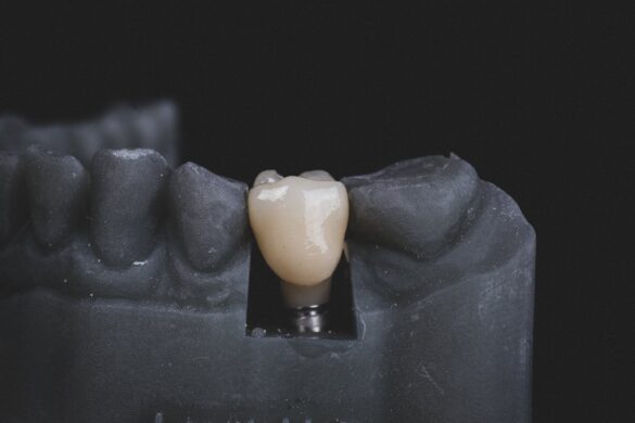 how do you care for new dental implants