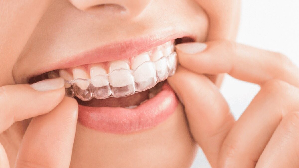 How Long Does It Take To See Results From Aligners?
