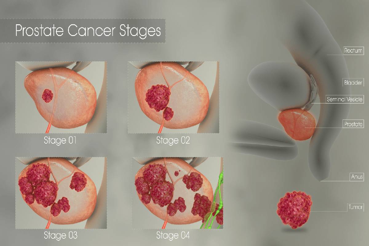 Prostate Cancer Stages