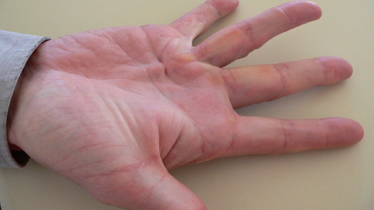 What are the risks of Dupuytren’s Contracture, and Why does it occur?