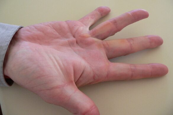 What are the risks of Dupuytren's Contracture