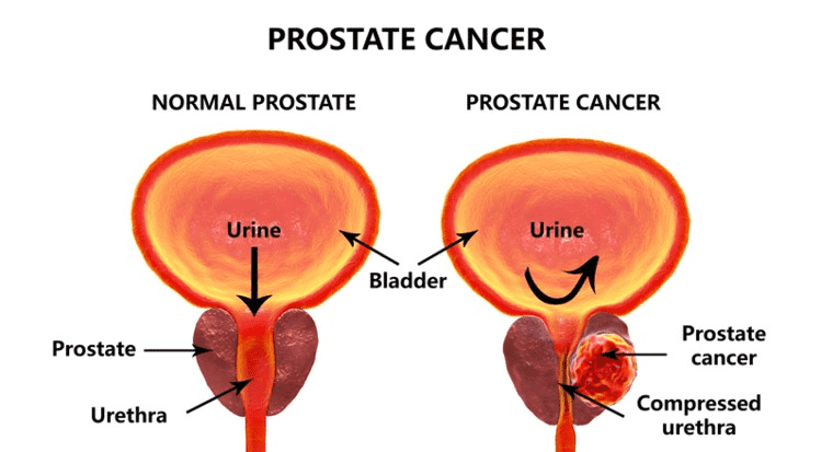 Prostate Cancer